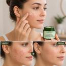 Acne creme facial.